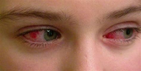 alerjik göz nezlesine ne iyi gelir